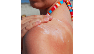 Sunscreen being rubbed on a sunburn
