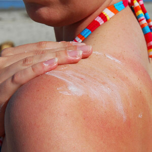 Rubbing sunscreen on burnt skin