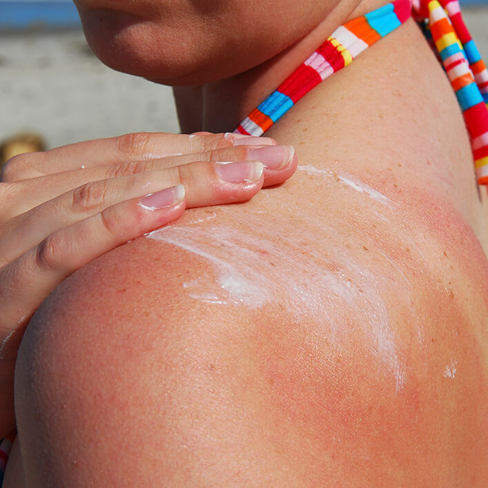 Rubbing sunscreen on burnt skin